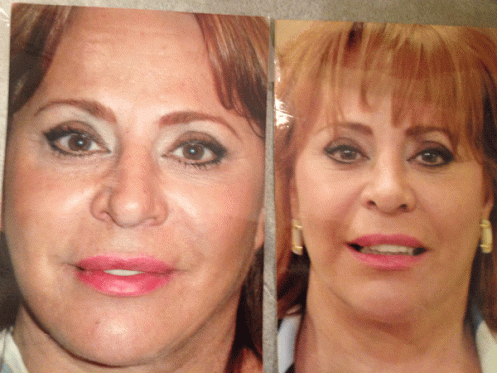 Margherite's Before and After photo of Juvederm, disappearance of marionette lines.